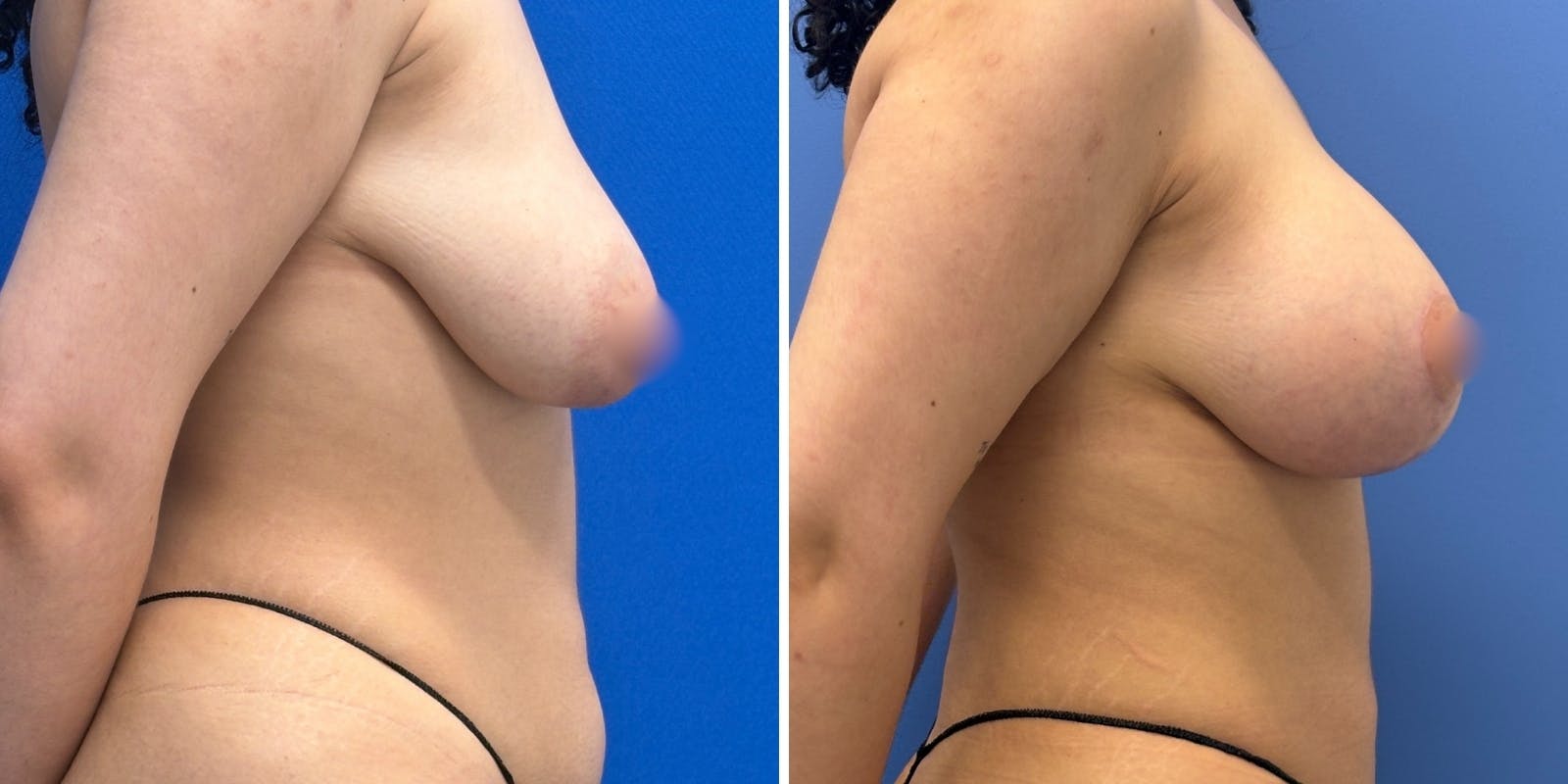 Breast Augmentation & Lift Before & After Gallery - Patient 636795 - Image 2