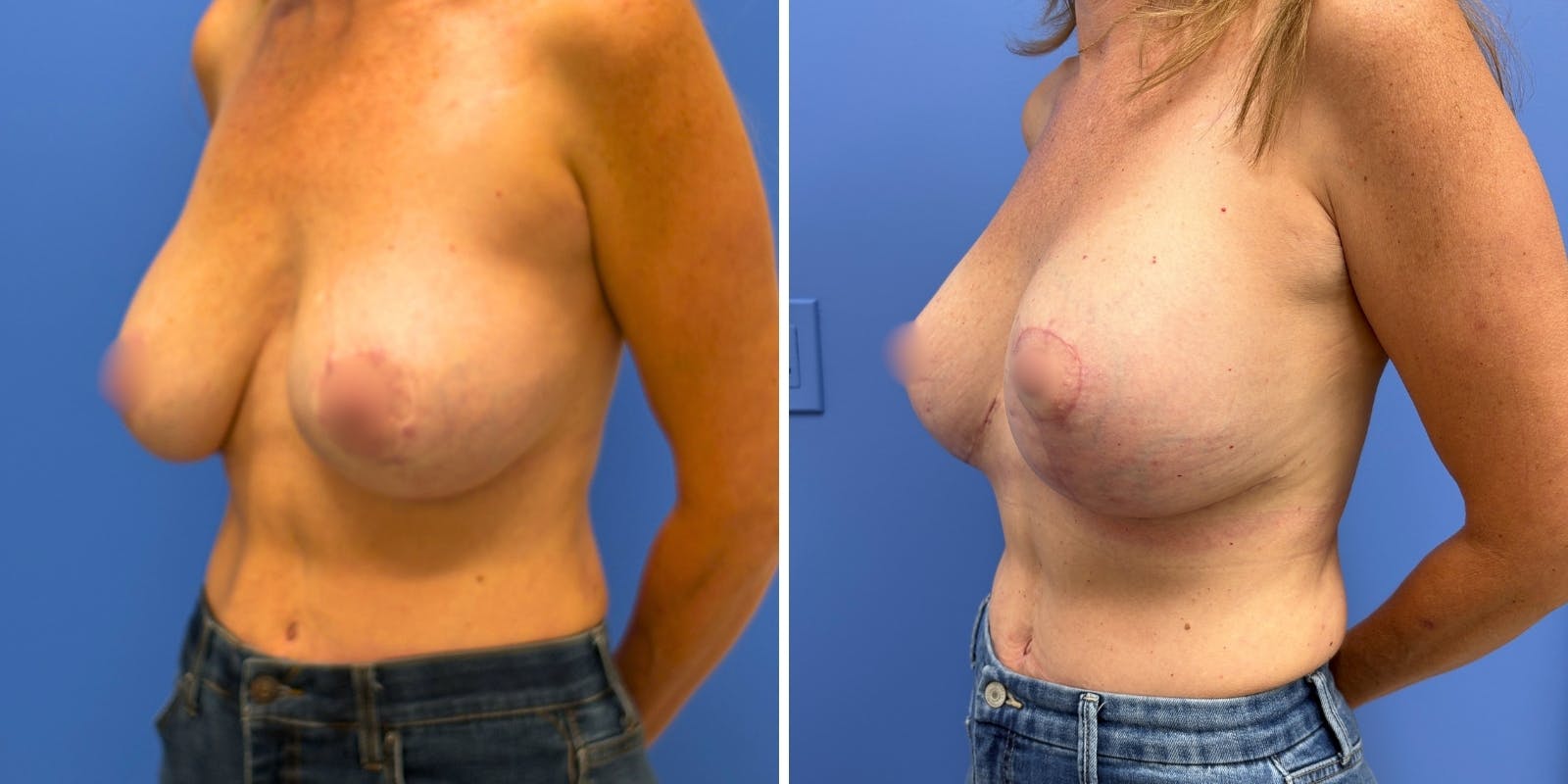 Breast Augmentation & Lift Before & After Gallery - Patient 363906 - Image 2