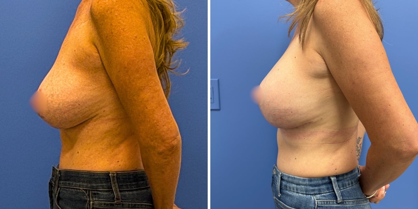Breast Augmentation & Lift Before & After Gallery - Patient 363906 - Image 3