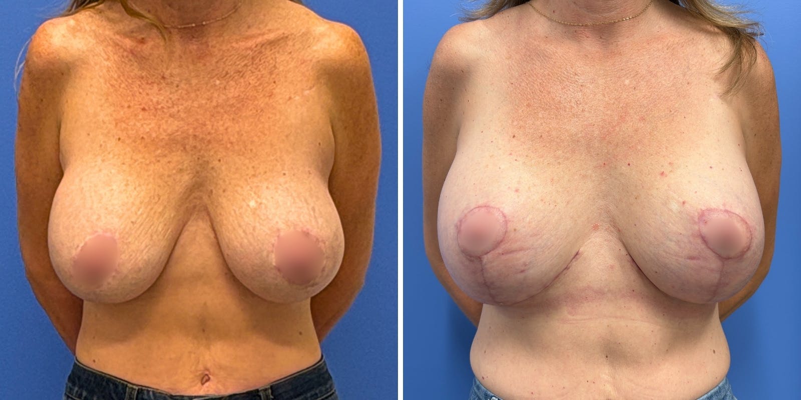 Breast Augmentation & Lift Before & After Gallery - Patient 363906 - Image 1