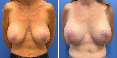 Breast Augmentation & Lift Before & After Gallery - Patient 363906 - Image 1