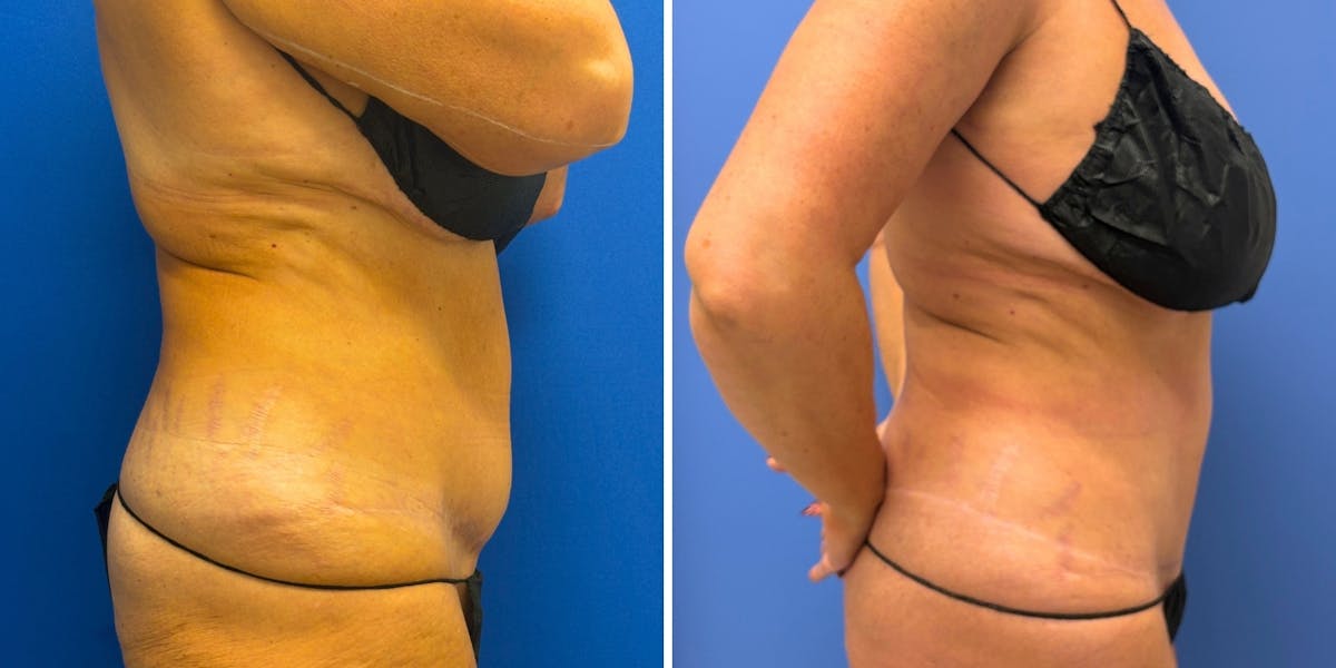 Liposuction Before & After Gallery - Patient 324612 - Image 2