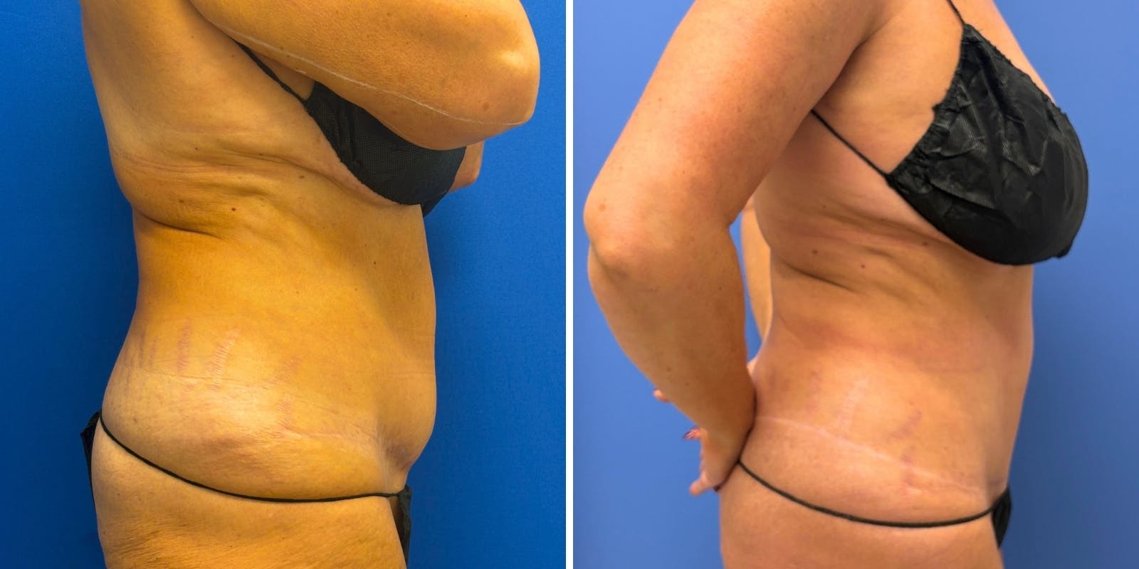 Liposuction Before & After Gallery - Patient 324612 - Image 2