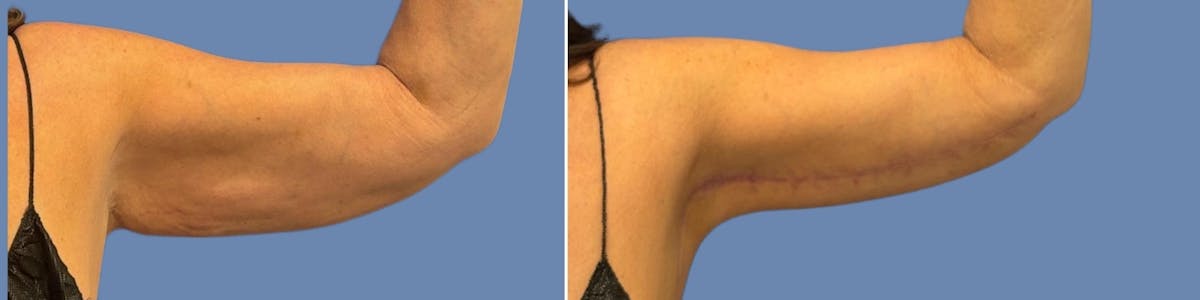 Liposuction Before & After Gallery - Patient 324612 - Image 4