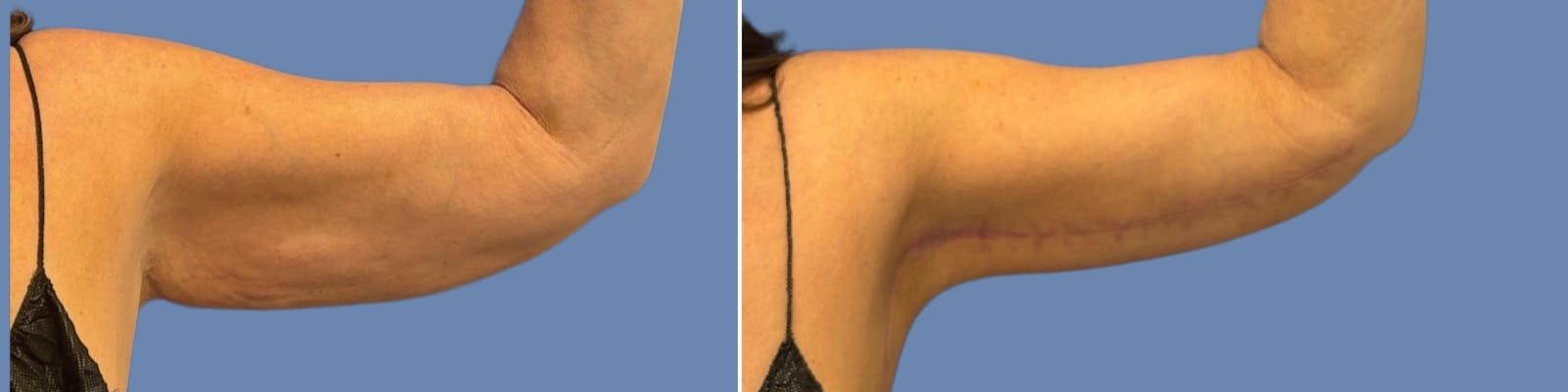 Liposuction Before & After Gallery - Patient 324612 - Image 4