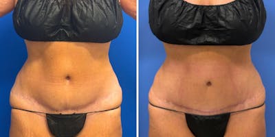 Liposuction Before & After Gallery - Patient 324612 - Image 1