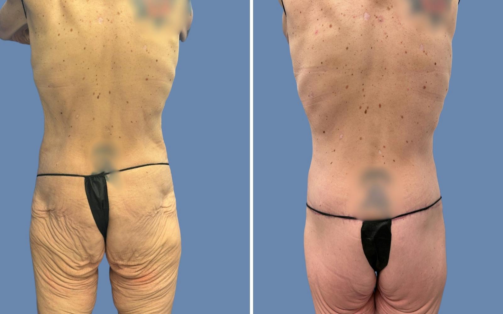 Body Lift Before & After Gallery - Patient 303509 - Image 3