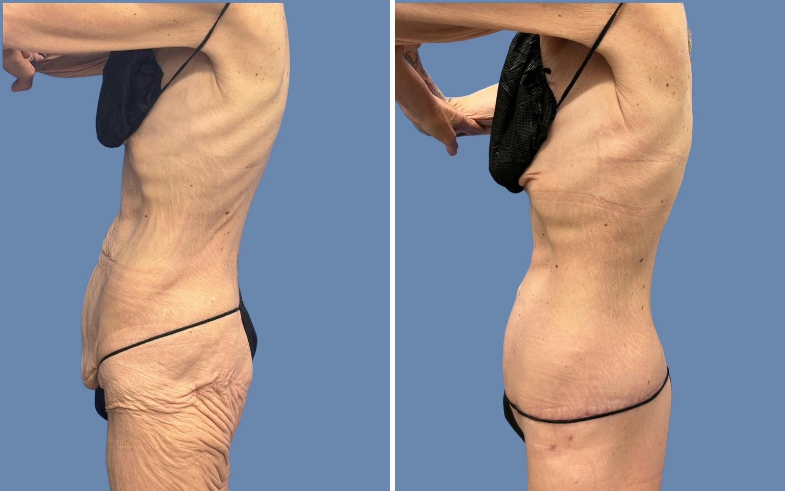 Body Lift Before & After Gallery - Patient 303509 - Image 2