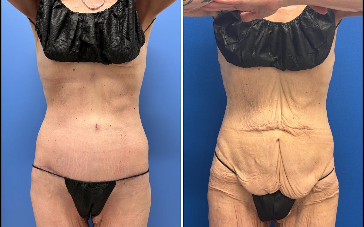 Body Lift Before & After Gallery - Patient 303509 - Image 1