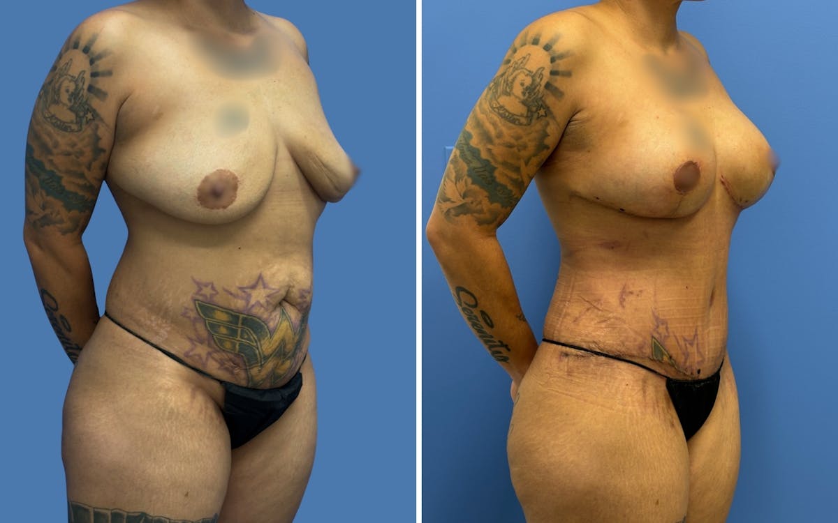Mommy Makeover Before & After Gallery - Patient 215539 - Image 2