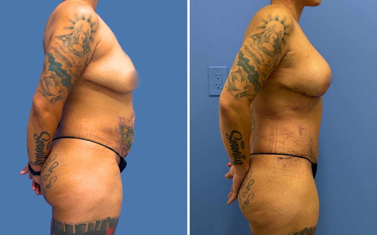 Mommy Makeover Before & After Gallery - Patient 215539 - Image 3