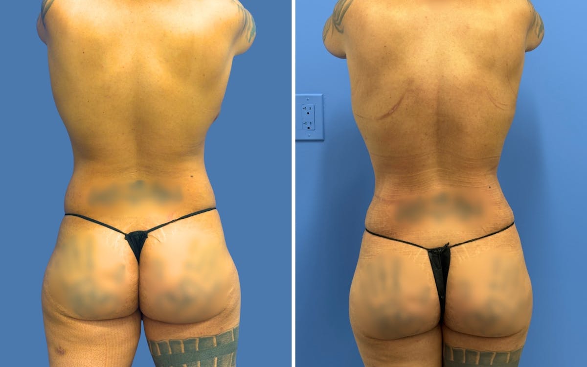Mommy Makeover Before & After Gallery - Patient 215539 - Image 4