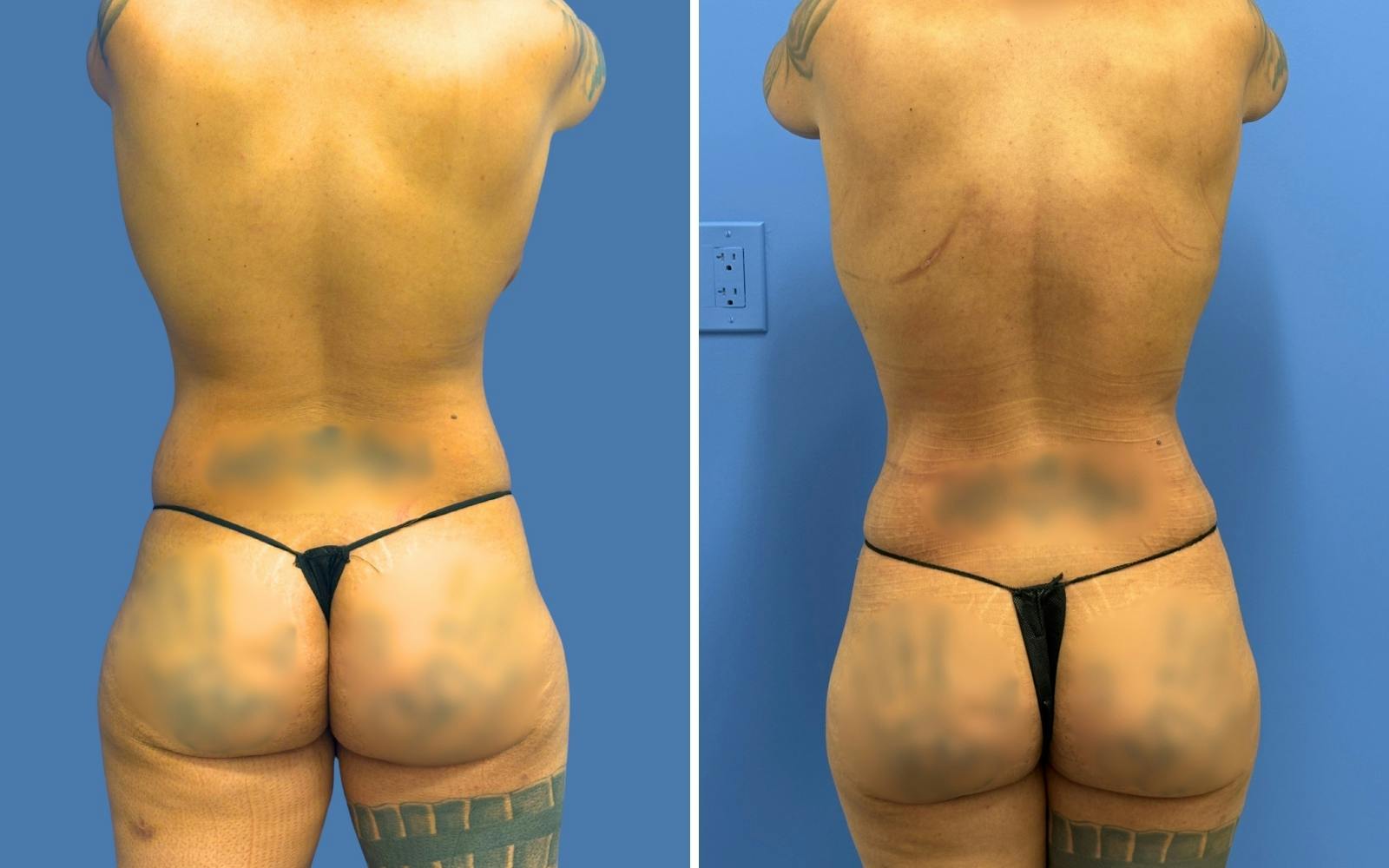 Mommy Makeover Before & After Gallery - Patient 215539 - Image 4