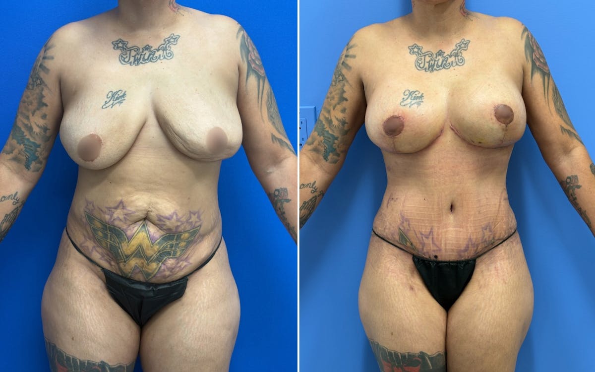 Mommy Makeover Before & After Gallery - Patient 215539 - Image 1
