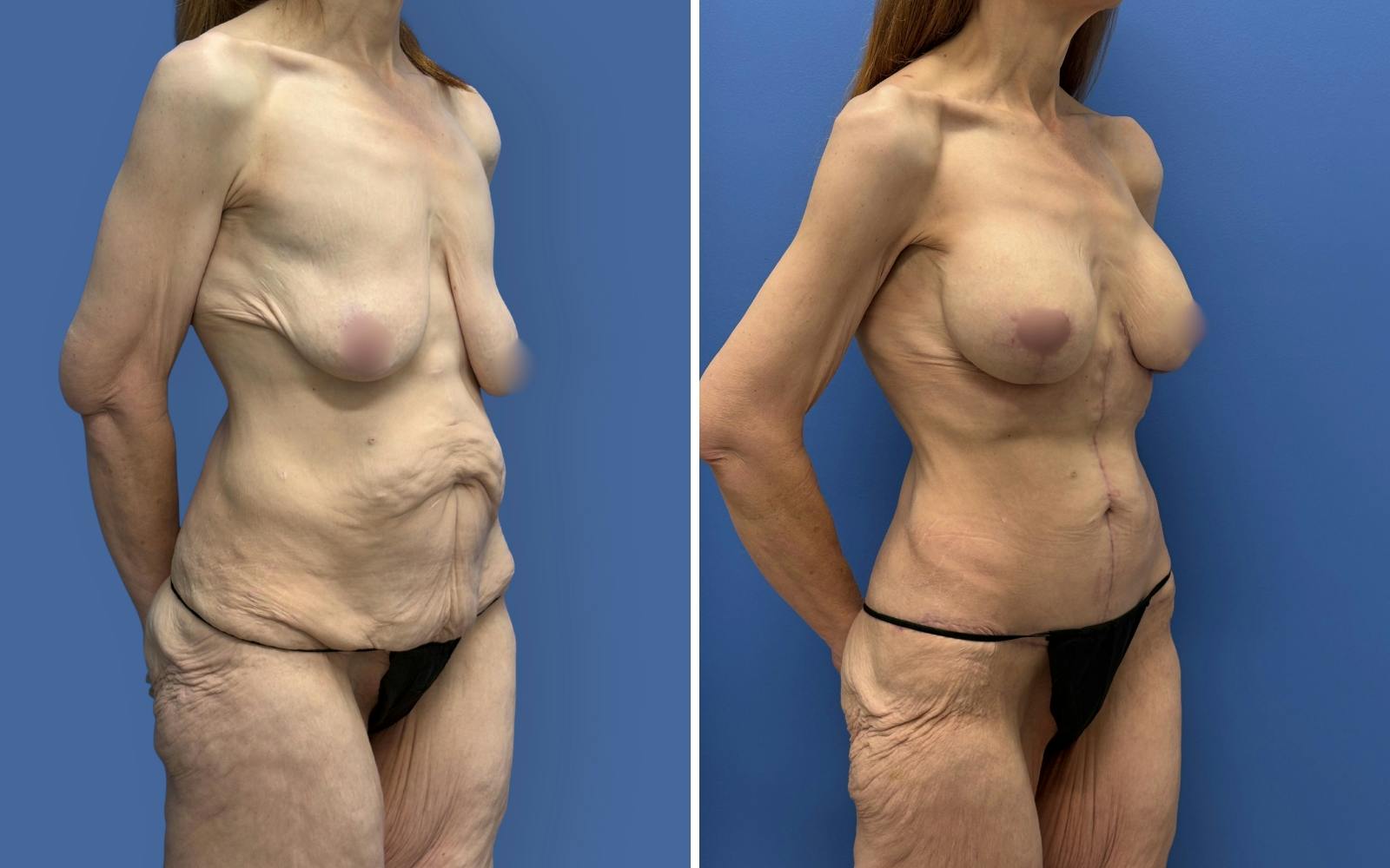 Mommy Makeover Before & After Gallery - Patient 611701 - Image 2
