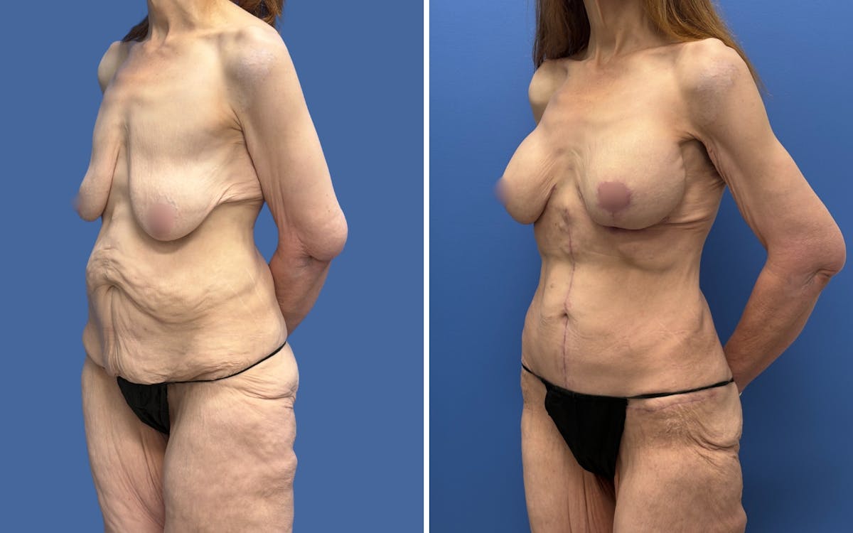 Mommy Makeover Before & After Gallery - Patient 611701 - Image 4