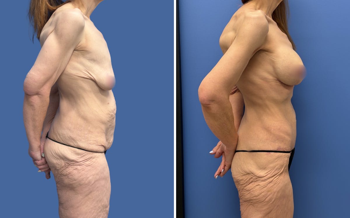 Mommy Makeover Before & After Gallery - Patient 611701 - Image 3