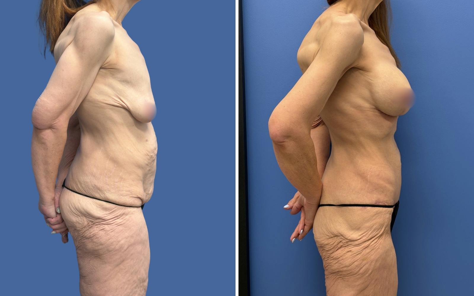 Mommy Makeover Before & After Gallery - Patient 611701 - Image 3