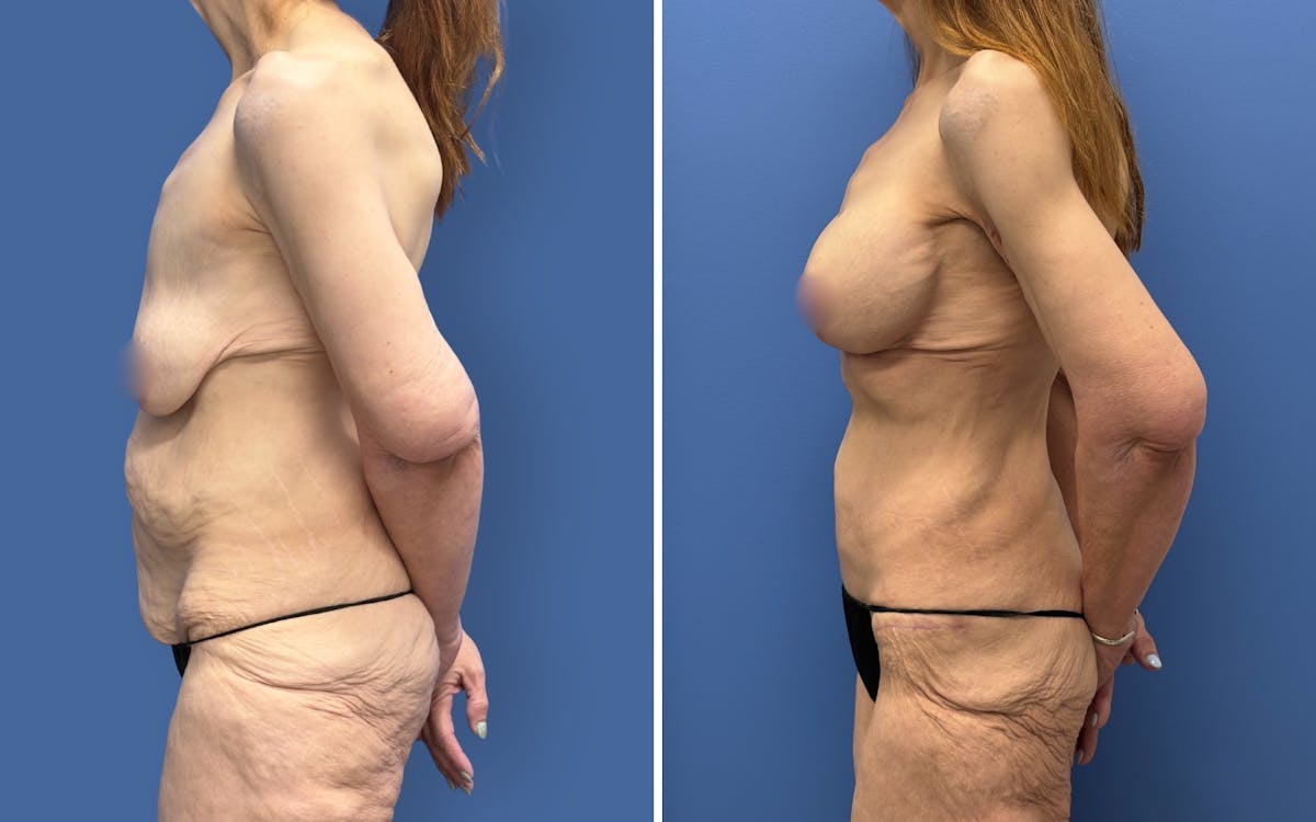 Mommy Makeover Before & After Gallery - Patient 611701 - Image 5