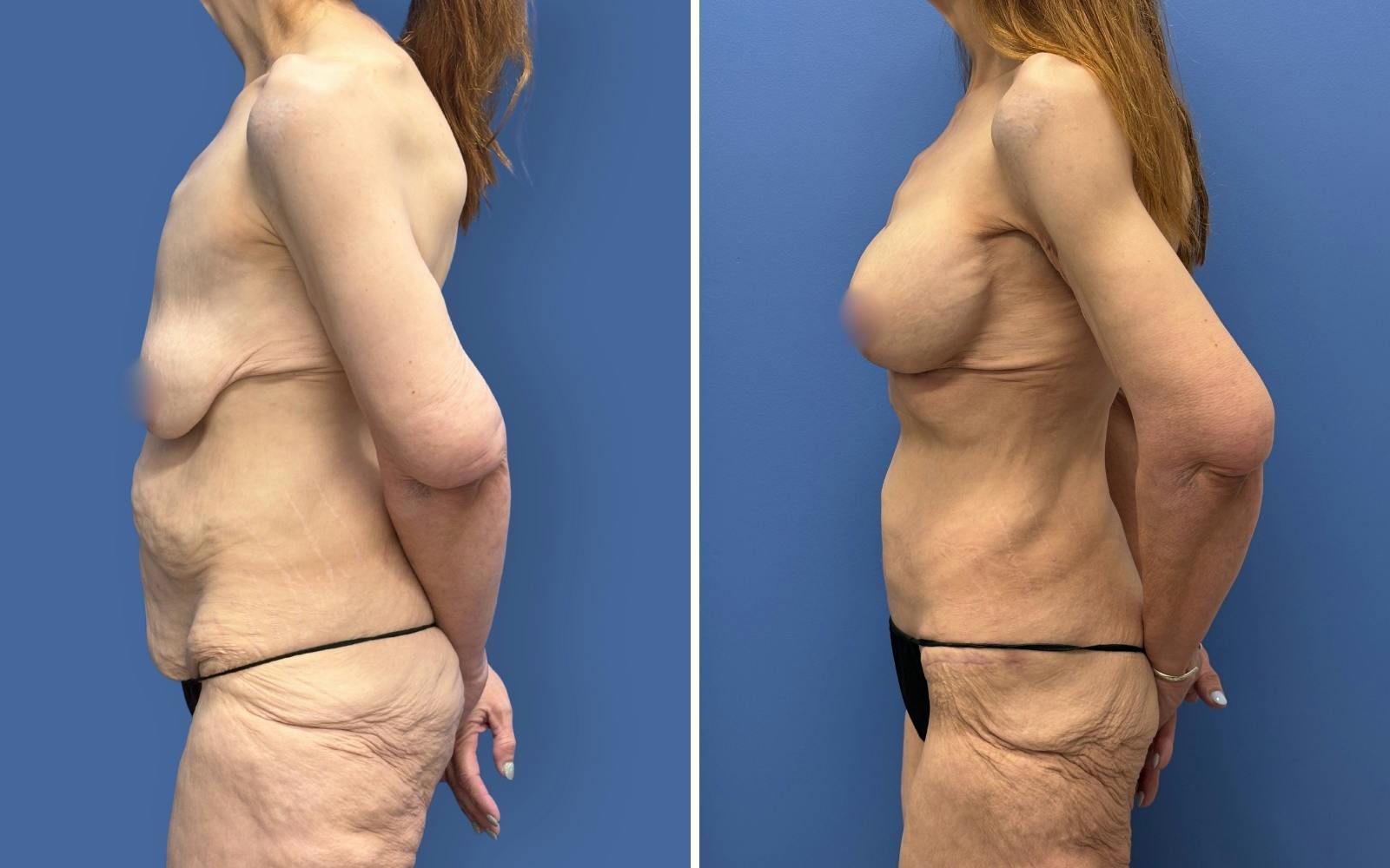 Mommy Makeover Before & After Gallery - Patient 611701 - Image 5