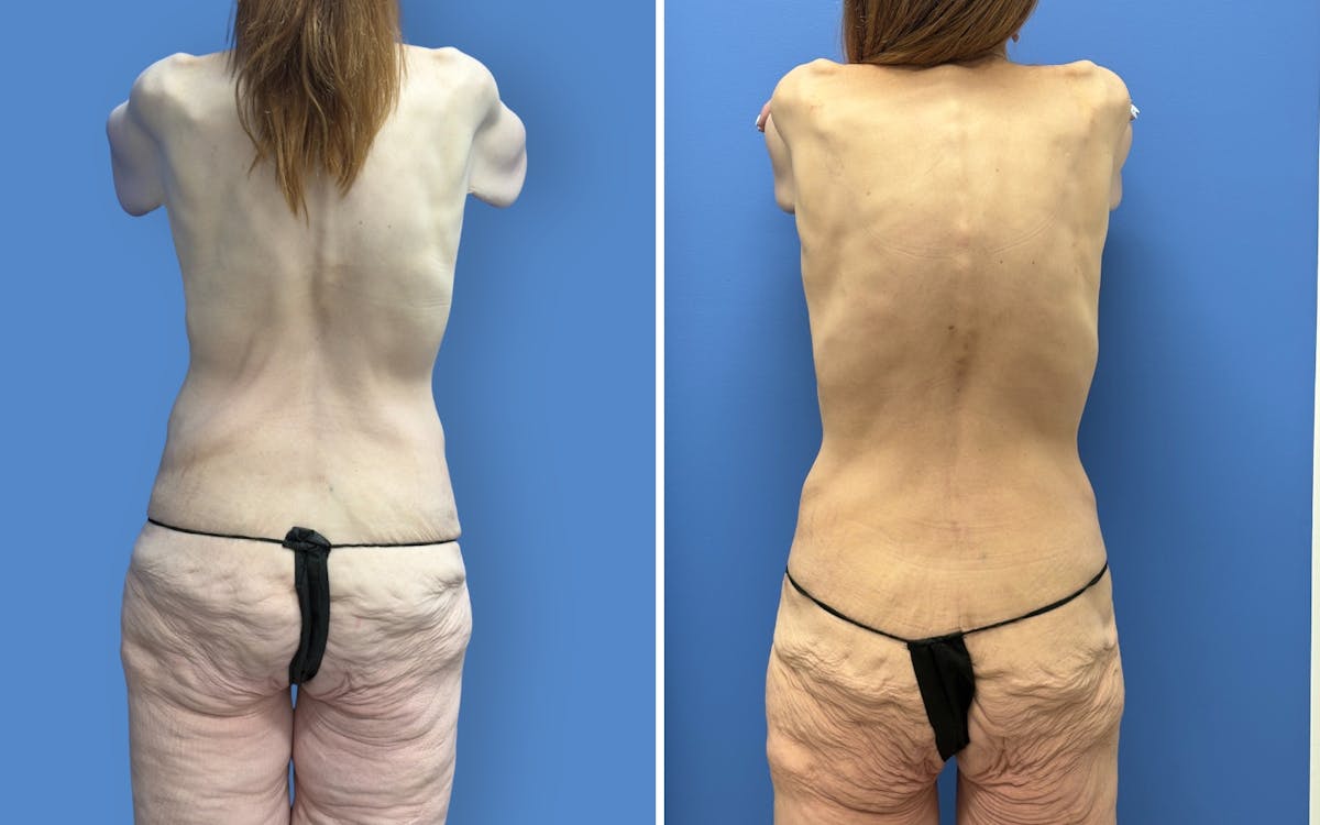 Mommy Makeover Before & After Gallery - Patient 611701 - Image 6