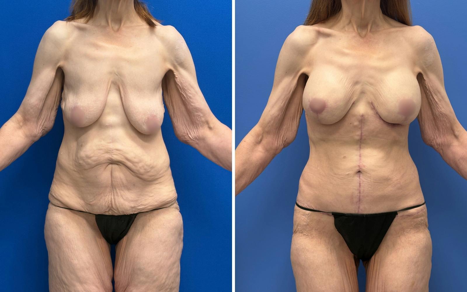 Mommy Makeover Before & After Gallery - Patient 611701 - Image 1