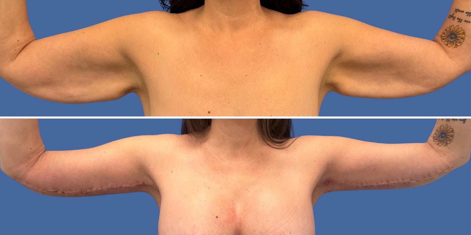 Brachioplasty Before & After Gallery - Patient 172421 - Image 1