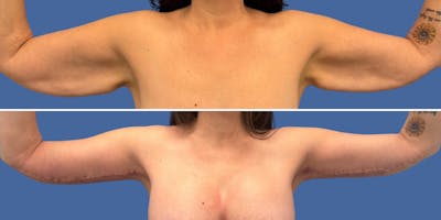 Brachioplasty Before & After Gallery - Patient 172421 - Image 1