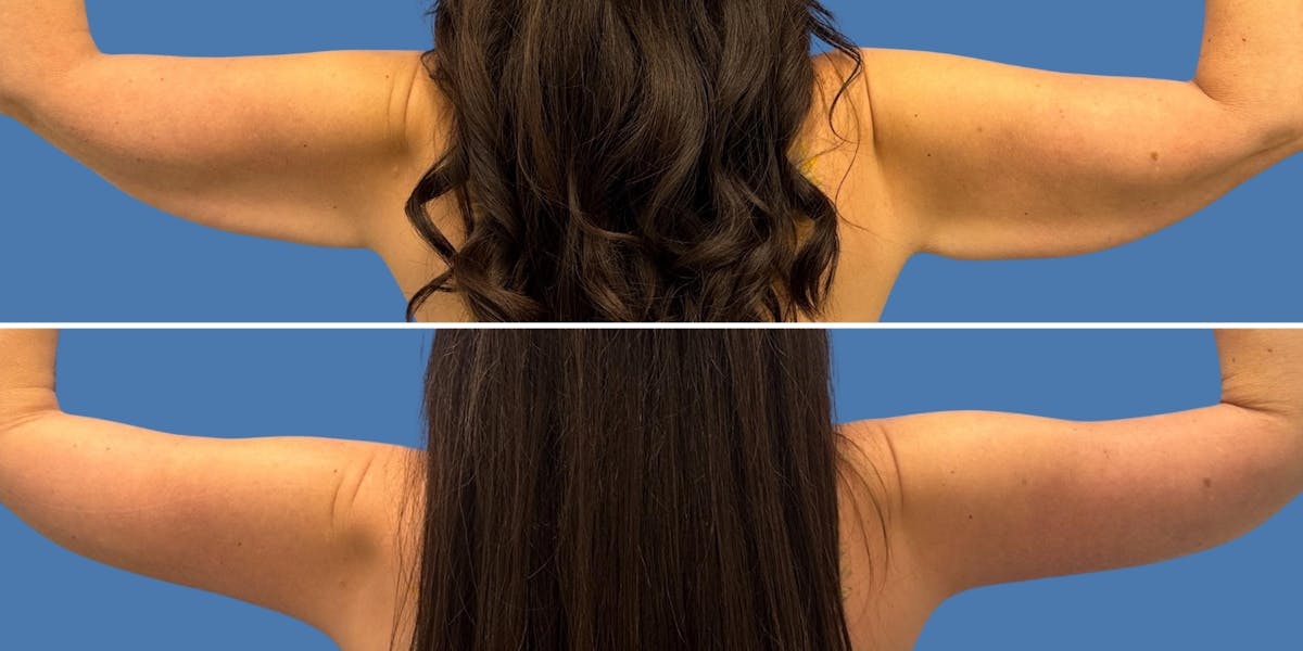 Brachioplasty Before & After Gallery - Patient 172421 - Image 2