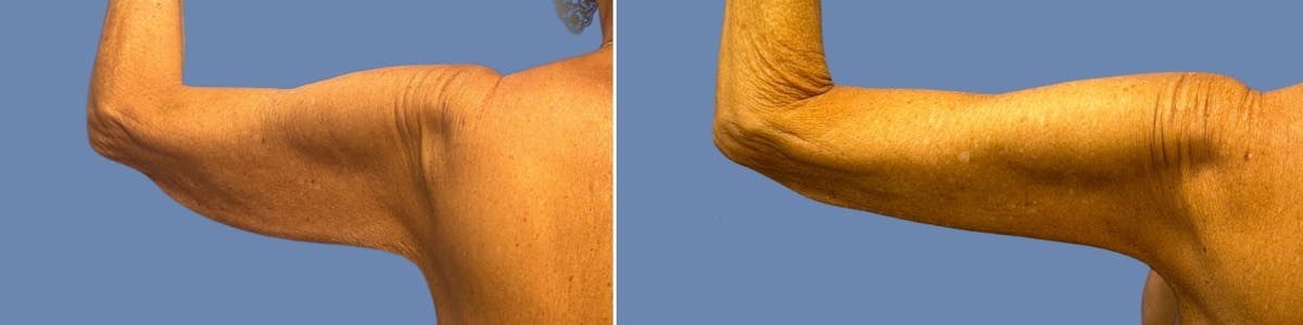 Brachioplasty Before & After Gallery - Patient 701281 - Image 3