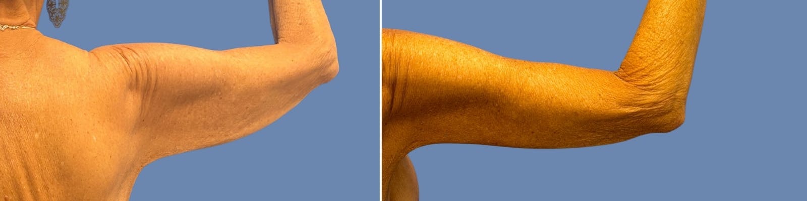 Brachioplasty Before & After Gallery - Patient 701281 - Image 1