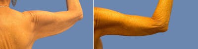 Brachioplasty Before & After Gallery - Patient 701281 - Image 1