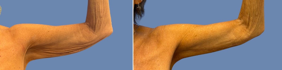 Brachioplasty Before & After Gallery - Patient 701281 - Image 2