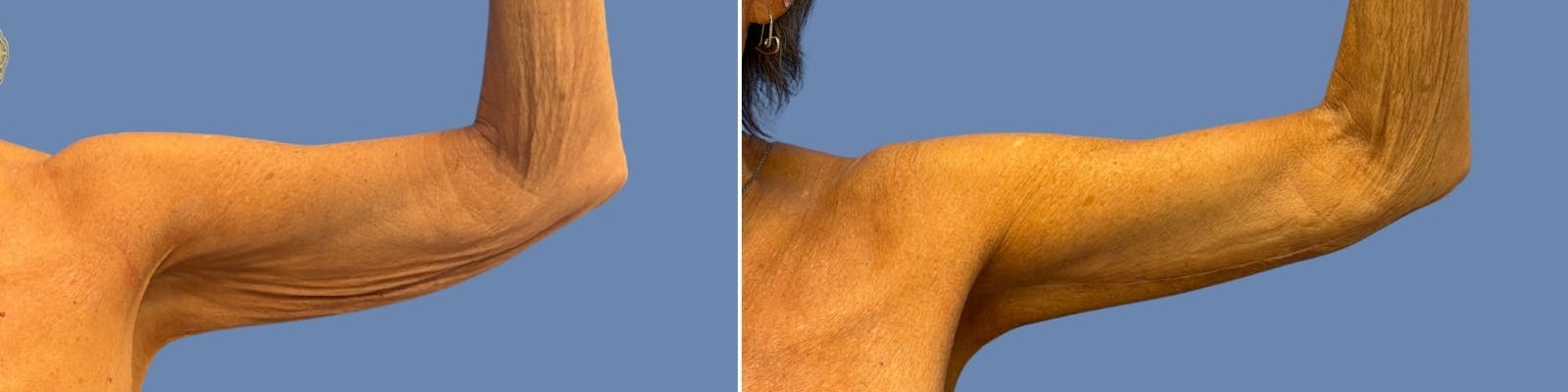 Brachioplasty Before & After Gallery - Patient 701281 - Image 2