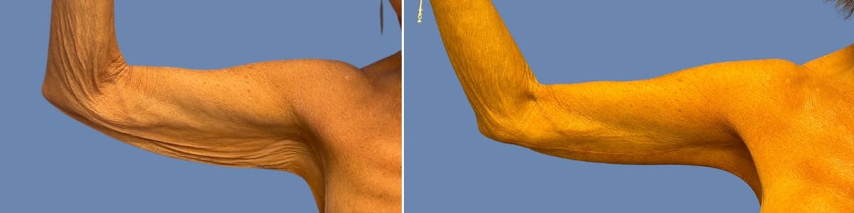 Brachioplasty Before & After Gallery - Patient 701281 - Image 4
