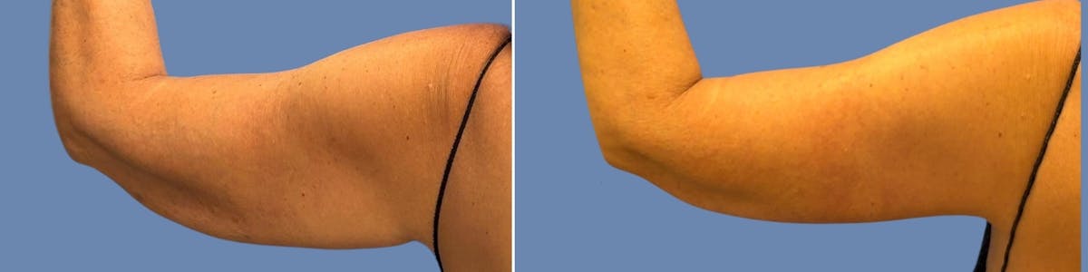 Brachioplasty Before & After Gallery - Patient 226117 - Image 2