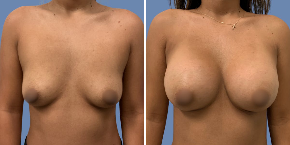 Breast Augmentation Before & After Gallery - Patient 219605 - Image 1