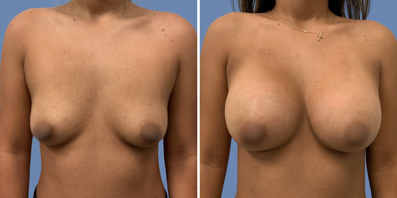 Patient dC2ExfVAQtiSCr9flcSo5w - Breast Augmentation Before & After Photos