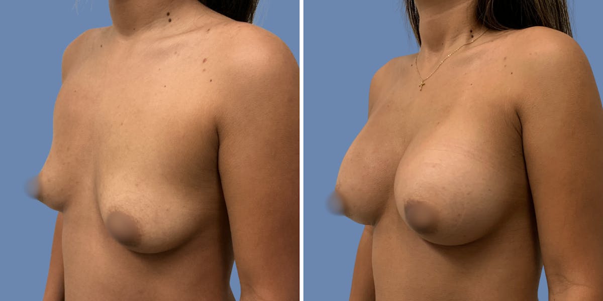 Breast Augmentation Before & After Gallery - Patient 219605 - Image 2