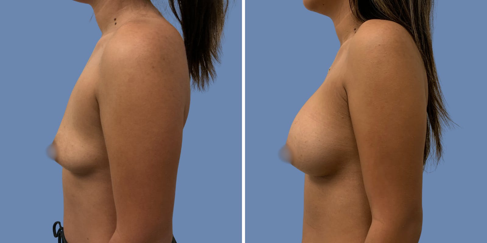 Breast Augmentation Before & After Gallery - Patient 219605 - Image 3
