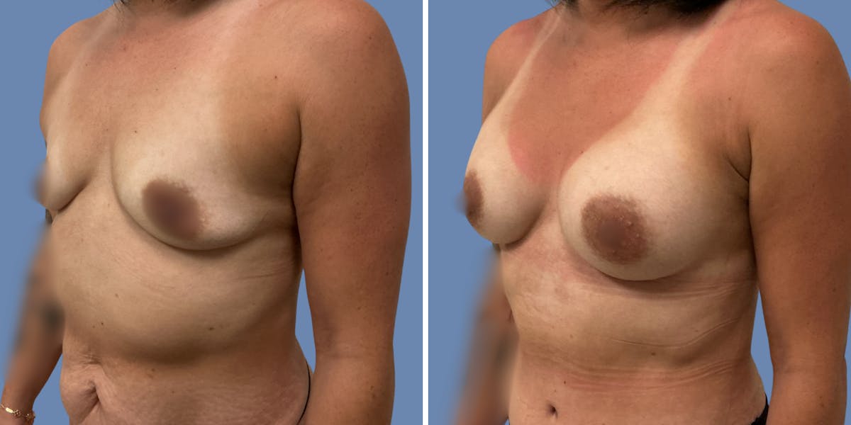 Abdominoplasty Before & After Gallery - Patient 376916 - Image 5