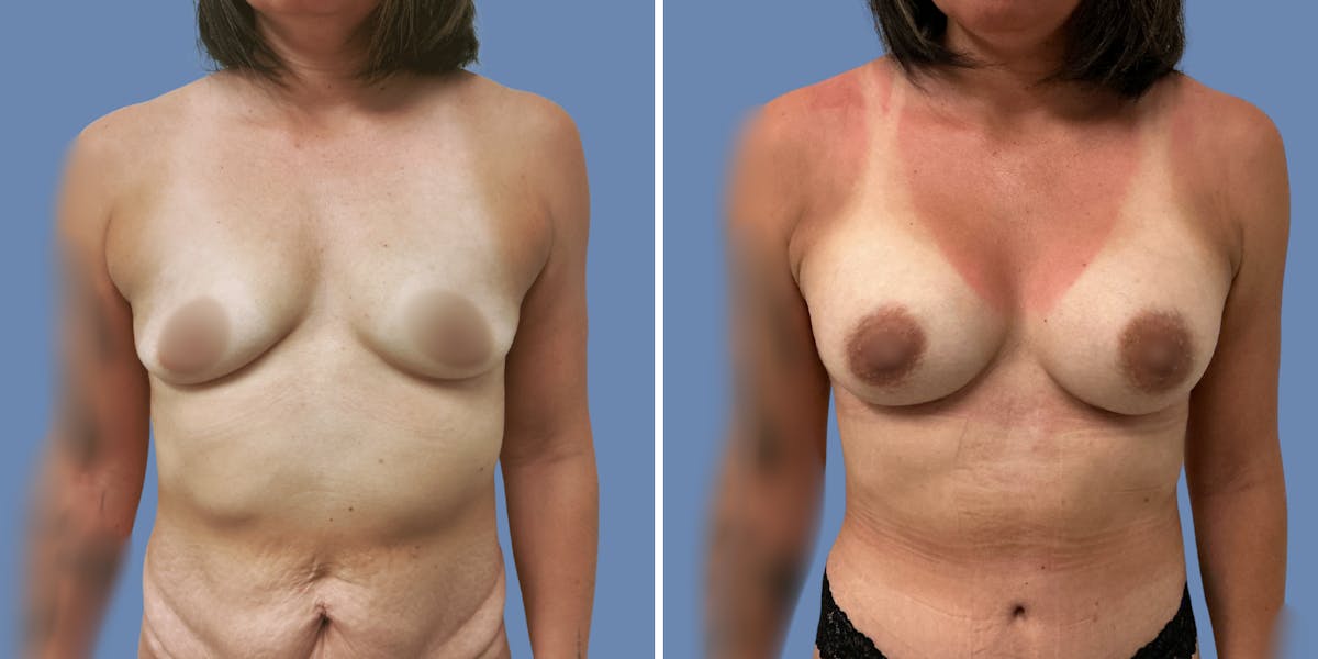 Abdominoplasty Before & After Gallery - Patient 376916 - Image 4