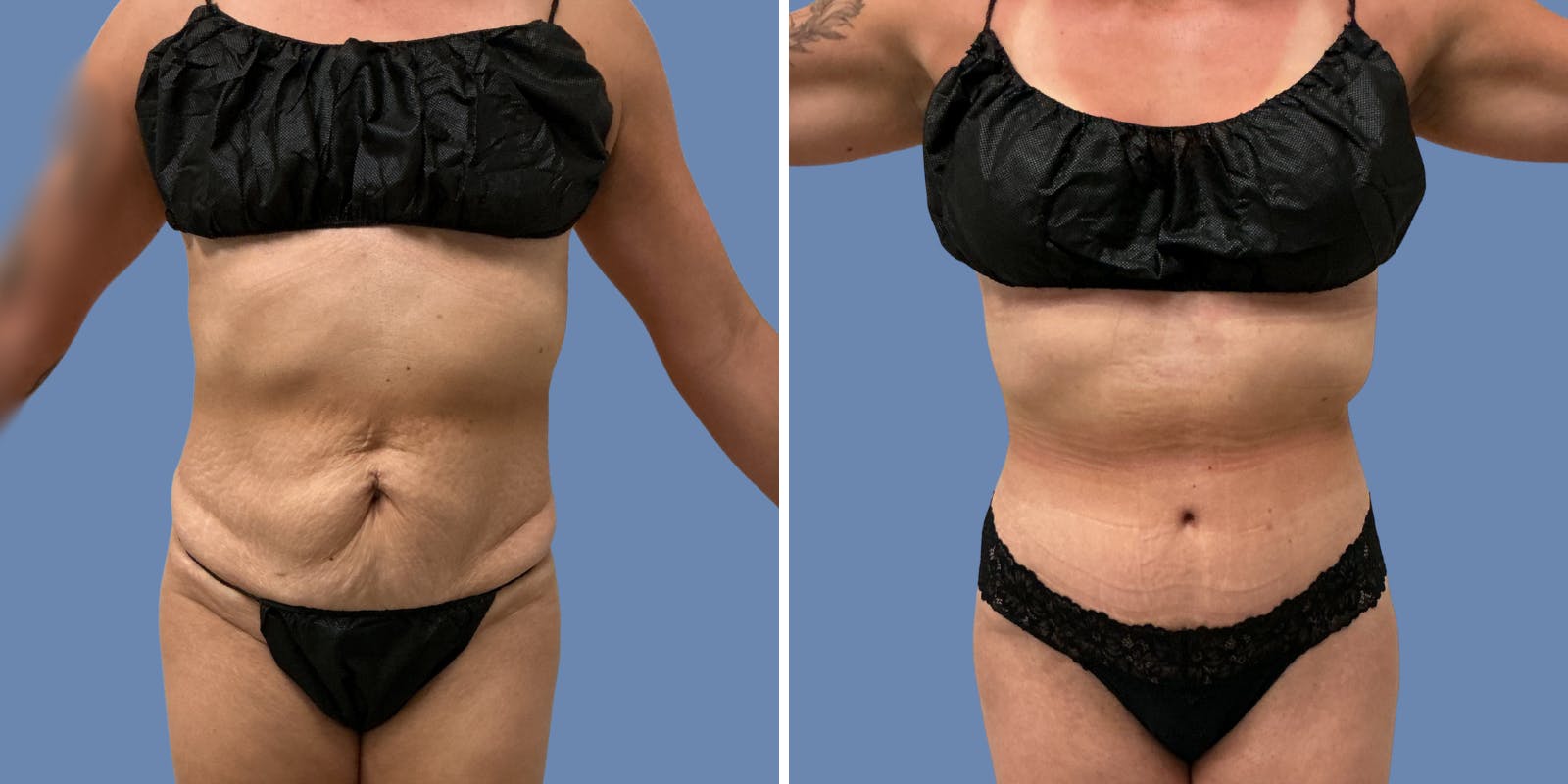 Abdominoplasty Before & After Gallery - Patient 376916 - Image 1