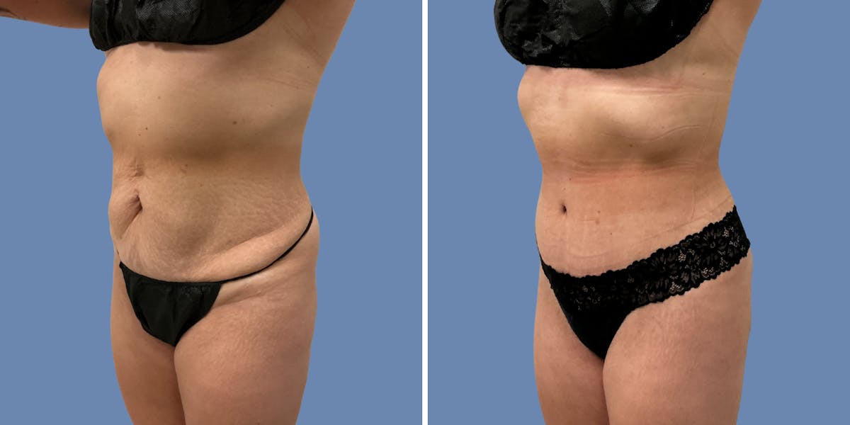 Abdominoplasty Before & After Gallery - Patient 376916 - Image 2