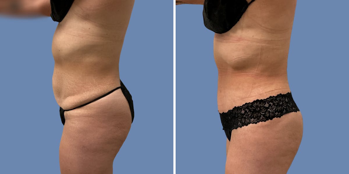 Abdominoplasty Before & After Gallery - Patient 376916 - Image 3