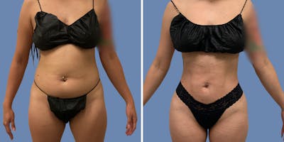 Liposuction Before & After Gallery - Patient 187020 - Image 1
