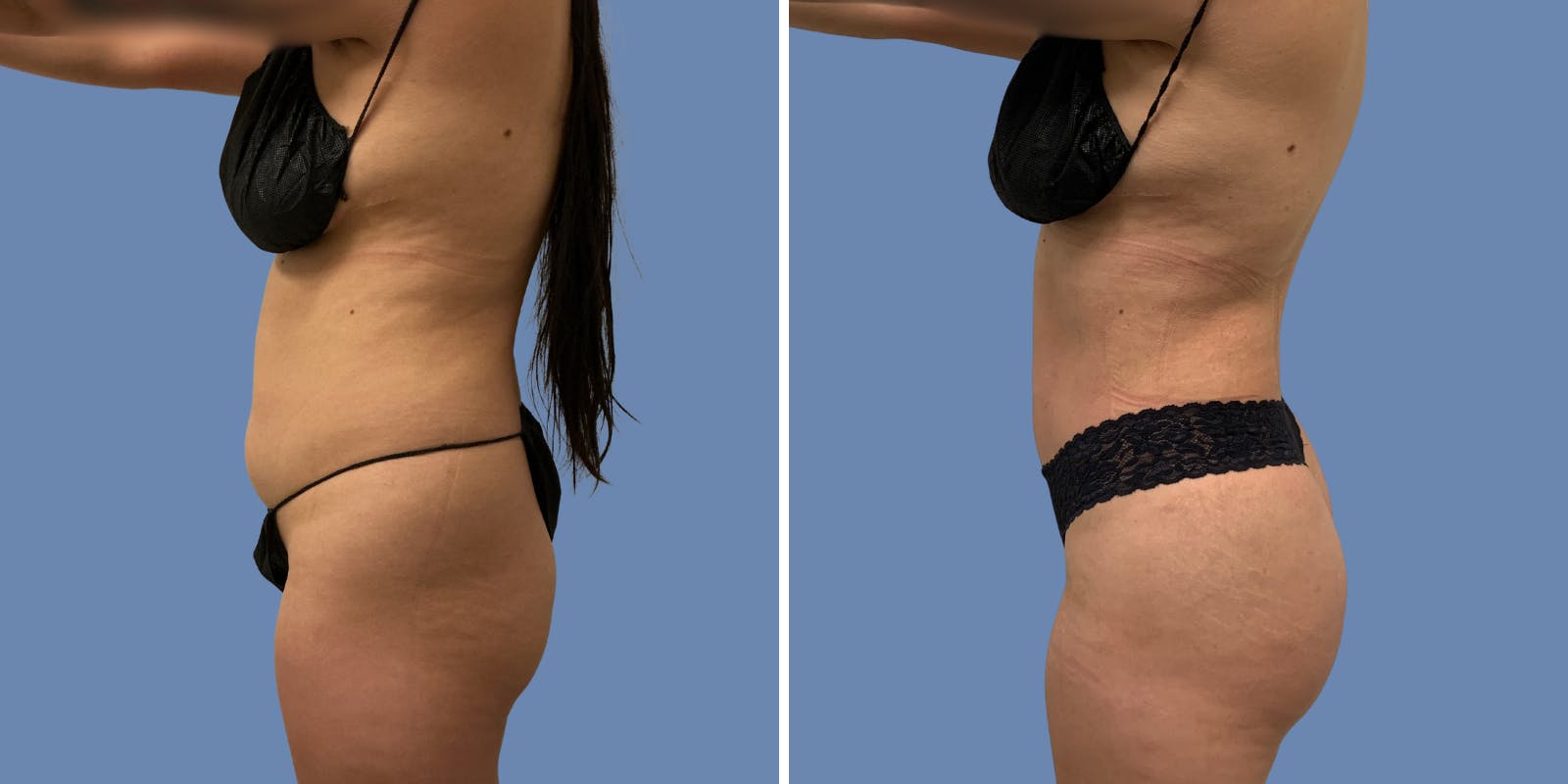 Liposuction Before & After Gallery - Patient 187020 - Image 3