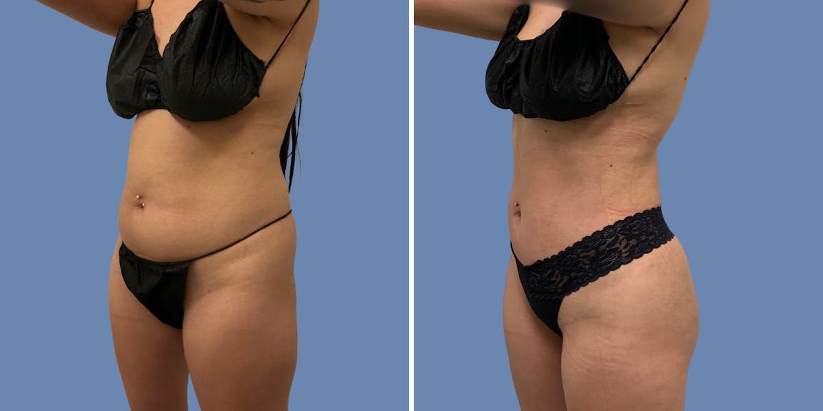Liposuction Before & After Gallery - Patient 187020 - Image 2