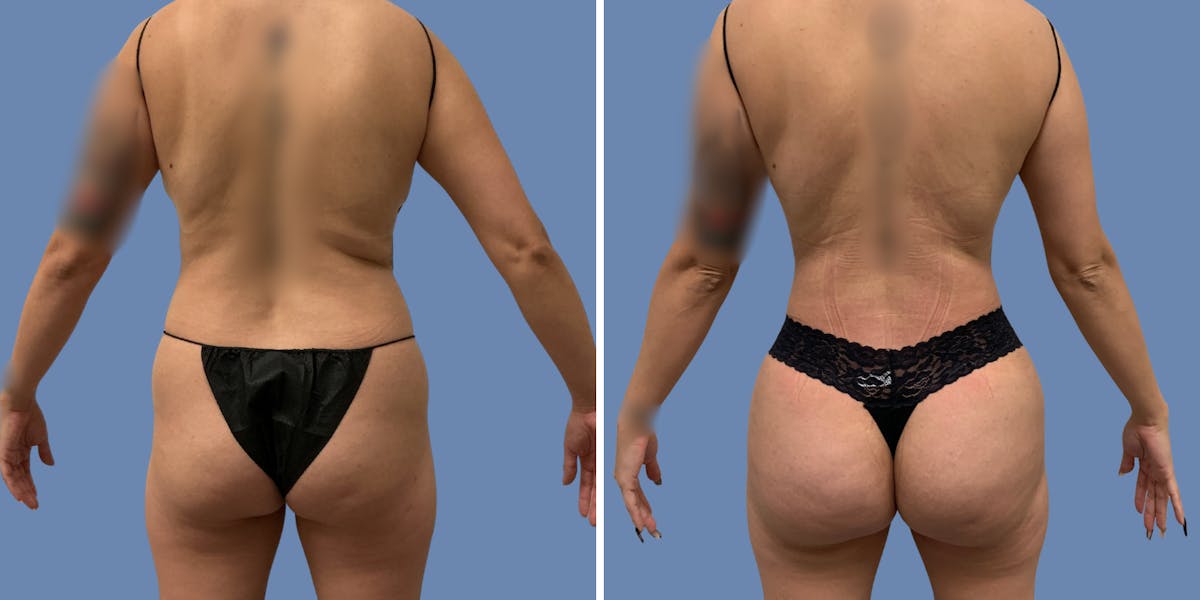 Liposuction Before & After Gallery - Patient 187020 - Image 4