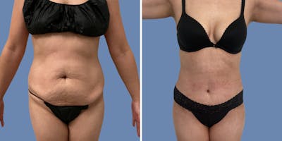 Abdominoplasty Before & After Gallery - Patient 386368 - Image 1